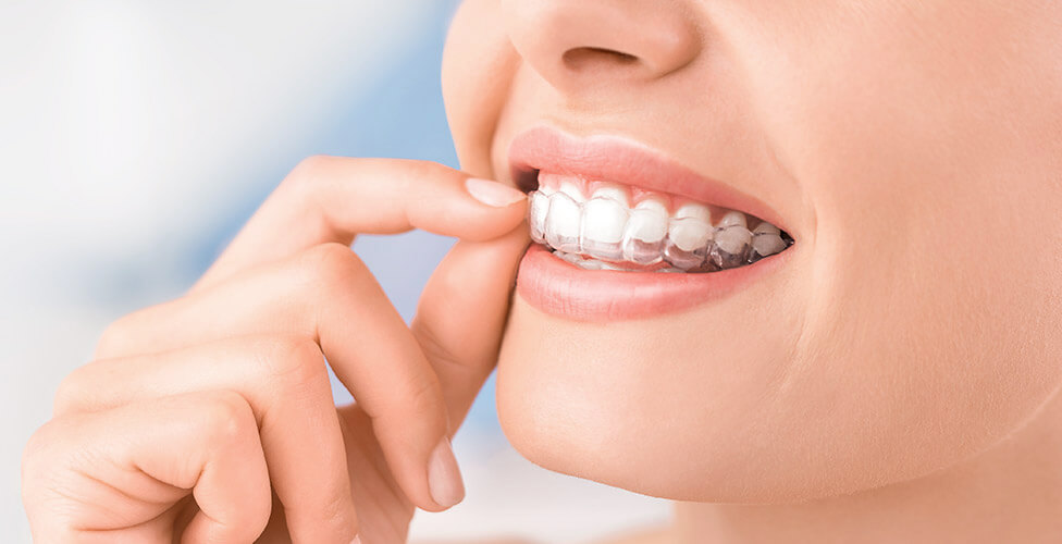 Como funciona invisalign