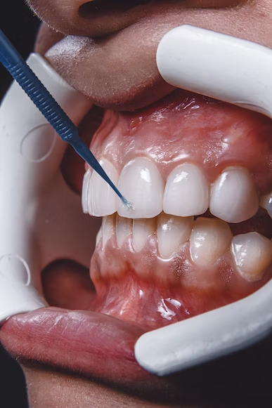 a close-up shot of a patient's mouth while a dentist is performing a dental procedure