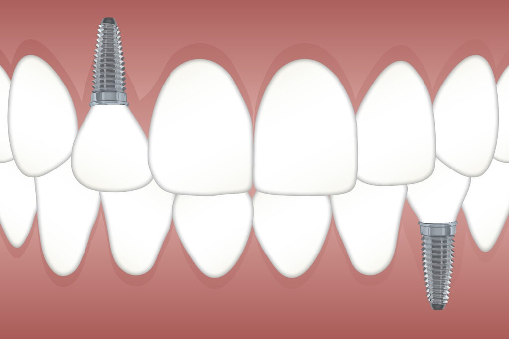 a graphic image of dental implants