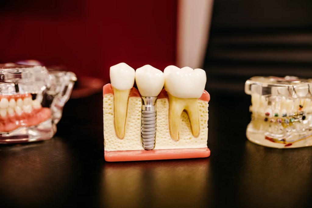 a dental model showing the dental implant between two normal teeth