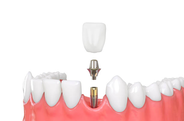 image of the different parts of a dental implant