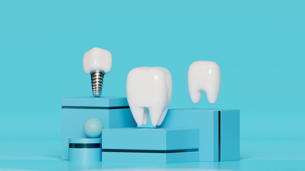 dental implants with a model of a tooth