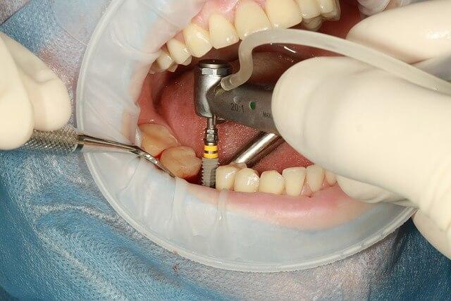 an image showing the installation of a dental implant