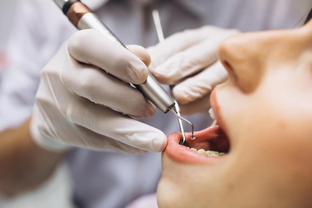 image of a dental cleaning