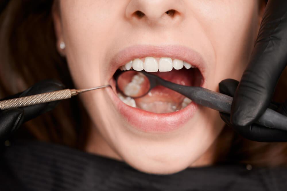 close-up shot of a flawless teeth