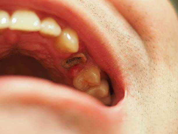an image showing a person's decayed tooth
