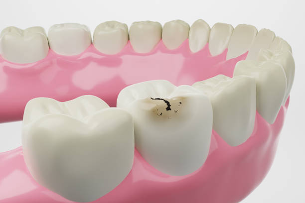 a digital image of a cracked tooth with cavity